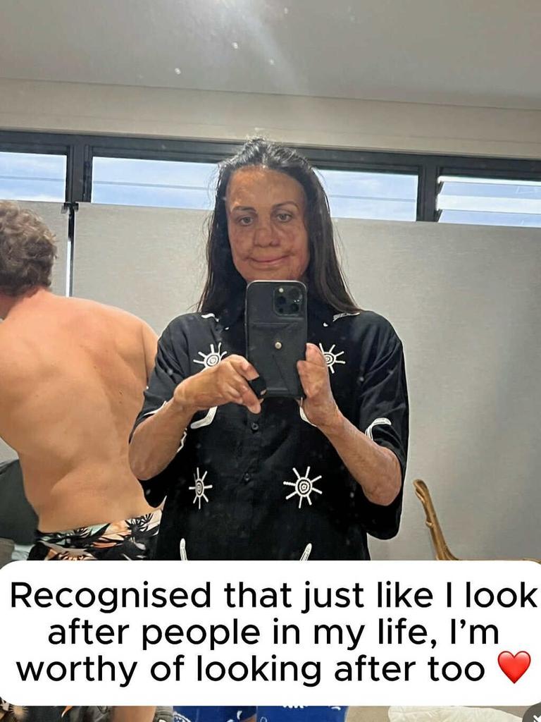 She detailed the brave steps she’s taken to combat it. Picture: Instagram