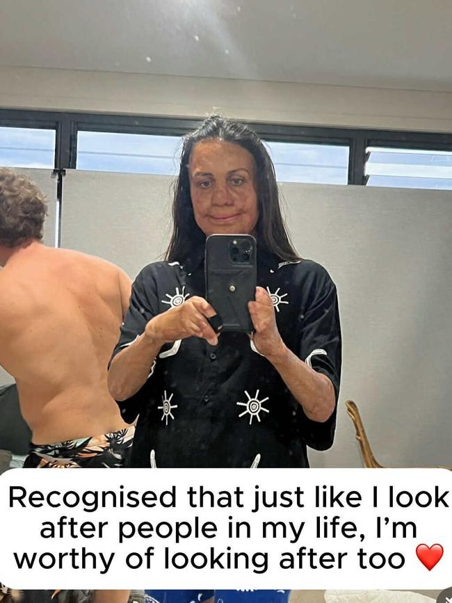 She detailed the brave steps she’s taken to combat it. Picture: Instagram