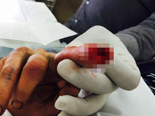 An alleged photo of Johnny Depp's finger from when he reportedly cut off the tip was included in Heard's court filing against the actor. Picture: TMZ