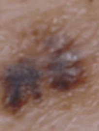 Some melanomas can develop with uneven colour, irregular shape and smudgy outline. Picture: Cancer Council NSW