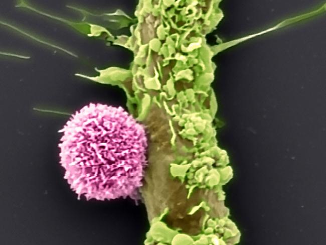 CAR T cells (pink) sitting on a breast cancer cells. These are electron microscopy pictures. Picture: Peter MacCallum Cancer Centre