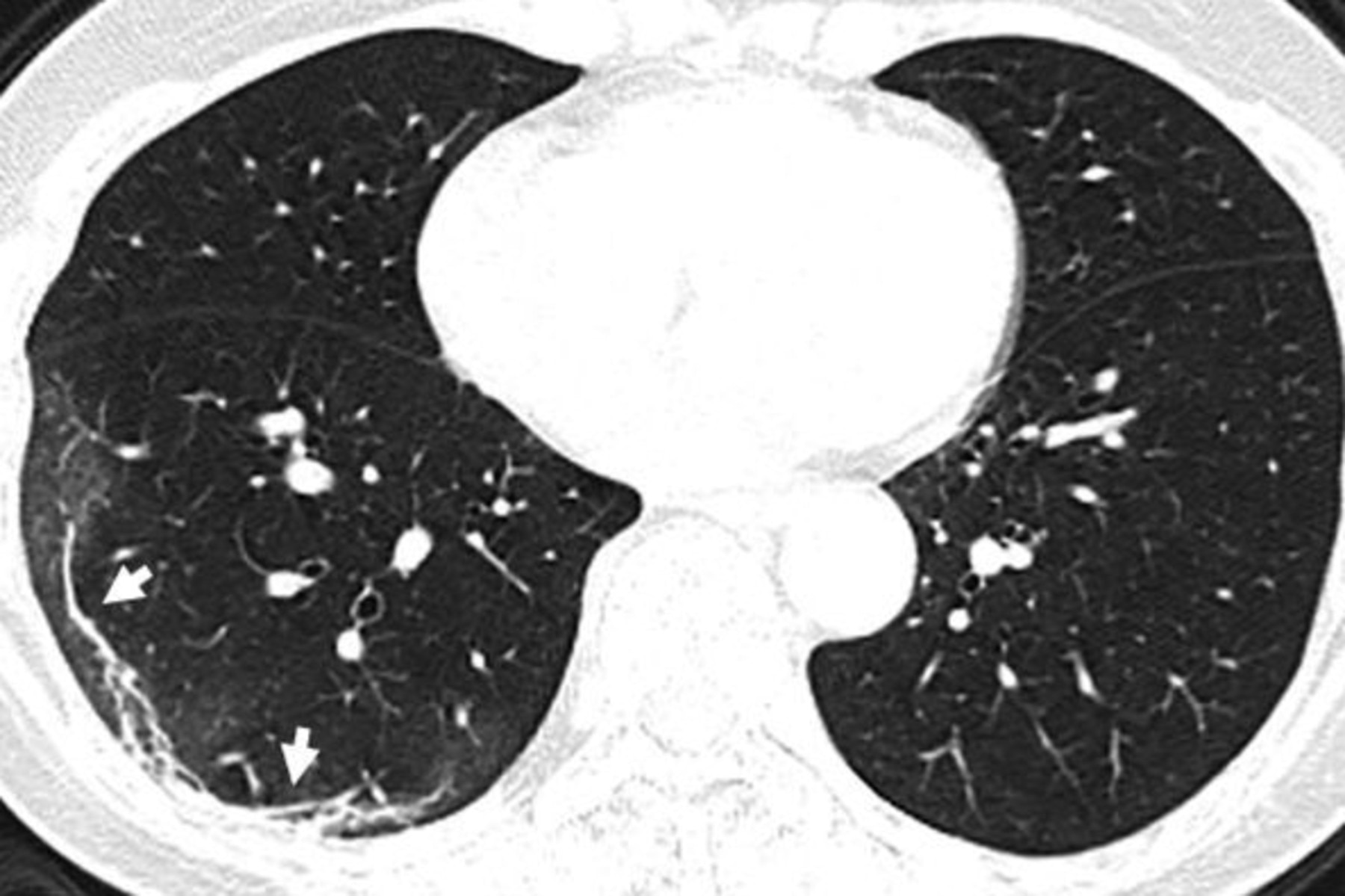 The images show white patches and a ‘reversed halo sign’ in the left upper lobe of her lung Picture: RSNA