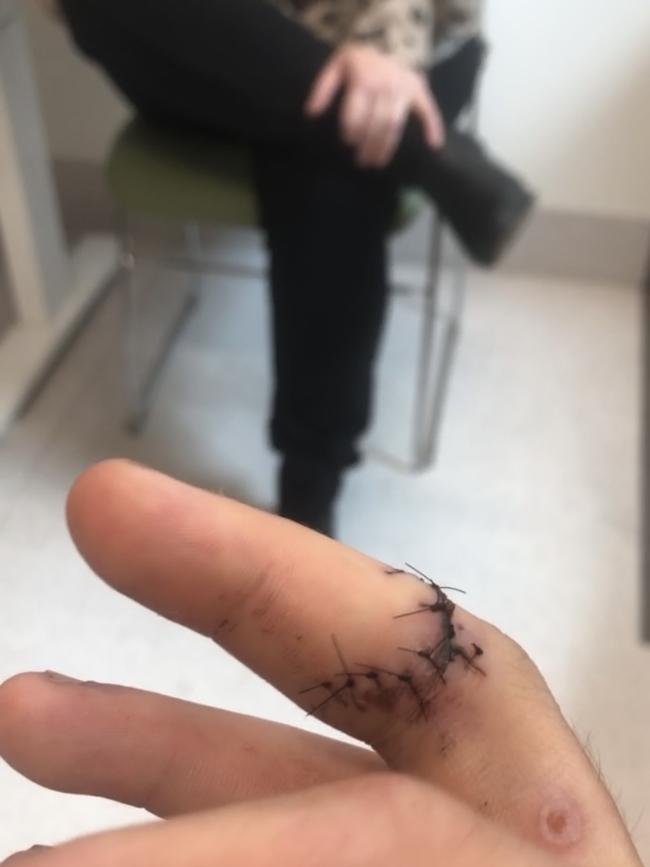 Jake Elias’ finger was also sliced open by the axe. Photo: Supplied