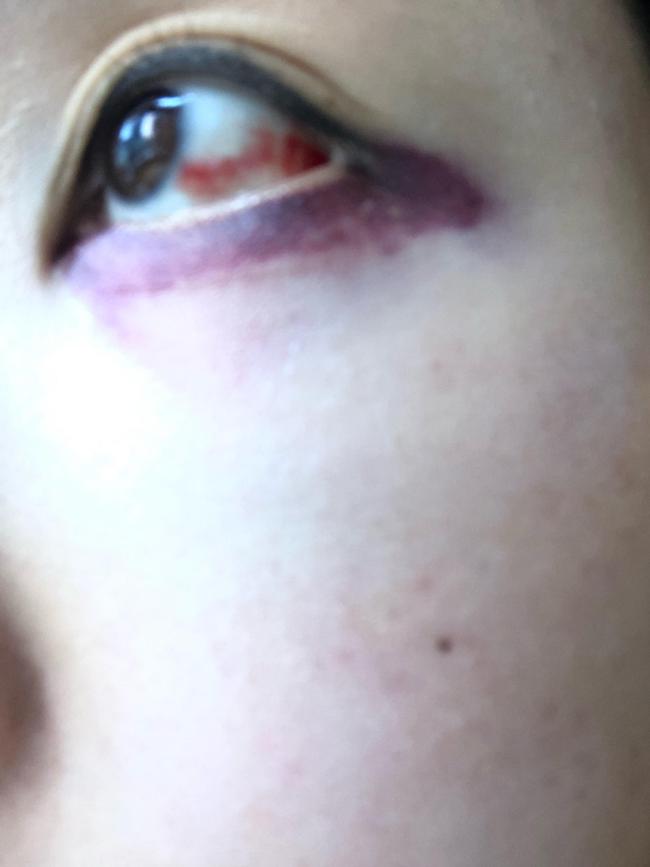 She sustained injuries to her eye in the random attack in Richmond.