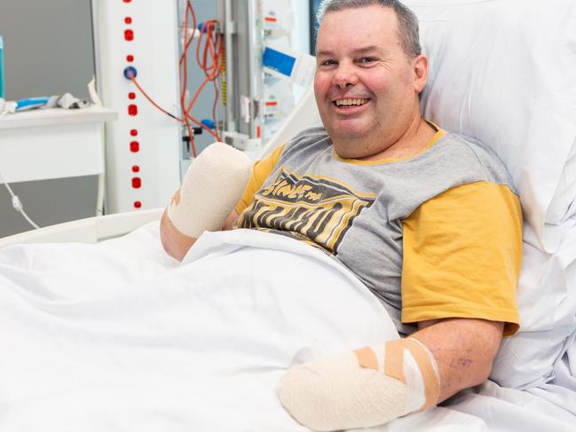 Buddy Miller in the Intensive Care Unit at Northern Beaches Hospital in Frenchs Forest. Buddy is recovering after having both of his hands amputated following sepsis, which nearly took his life. Picture: Jordan Shields.