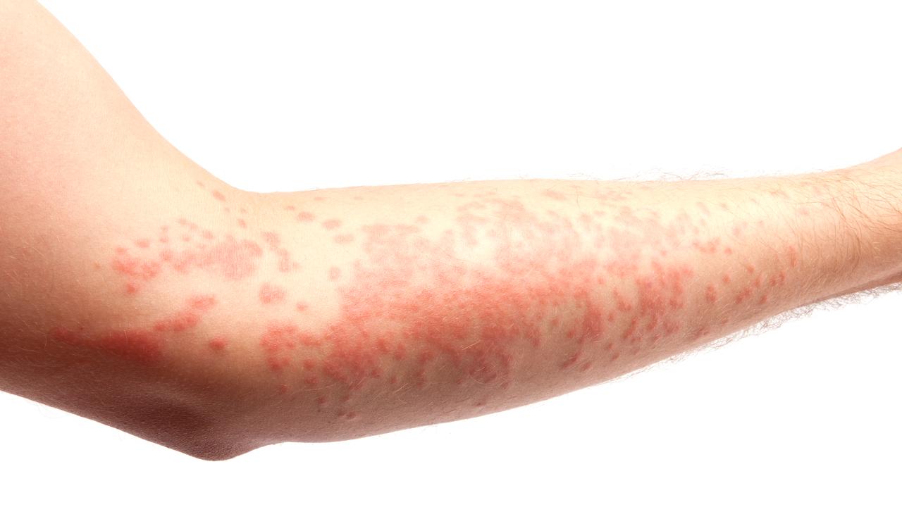 Some people with Covid in the UK have reported hives as one of their symptoms. Picture: iStock