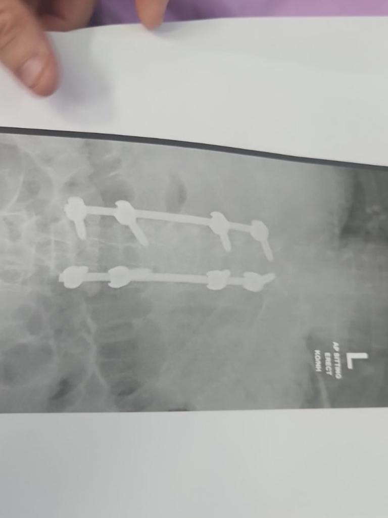 An X-ray reveals the metal rods now running down Chris Travis’s back.