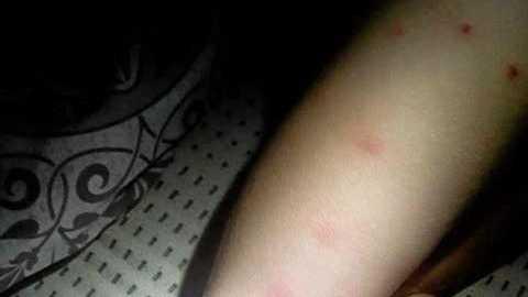 Bed bug bites on one of the children&#39;s legs. Picture: Contributed