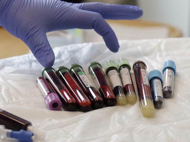 In this photo taken March 21, 2017, a nurse reaches for blood samples taken from a patient receiving a kind of immunotherapy known as CAR-T cell therapy at the Fred Hutchinson Cancer Research Center in Seattle. Immune therapy is the hottest trend in cancer care and its next frontier is creating "living drugs" that grow inside the body into an army that seeks and destroys tumors. (AP Photo/Elaine Thompson)