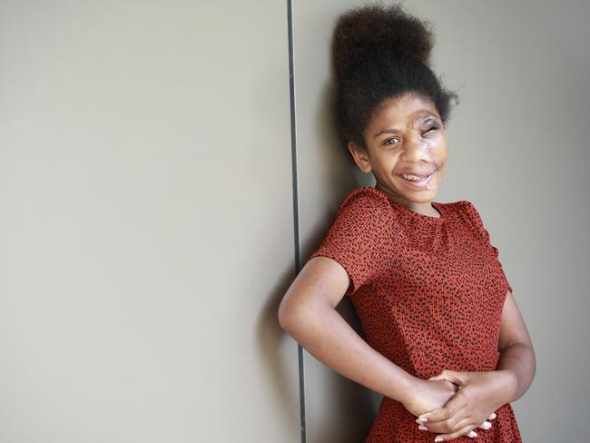 Jelsian Sur, 14, poses at the Queensland Children's Hospital. Her face is still swollen after a recent operation but she’s happy with the results. Picture: AAP Image/Claudia Baxter