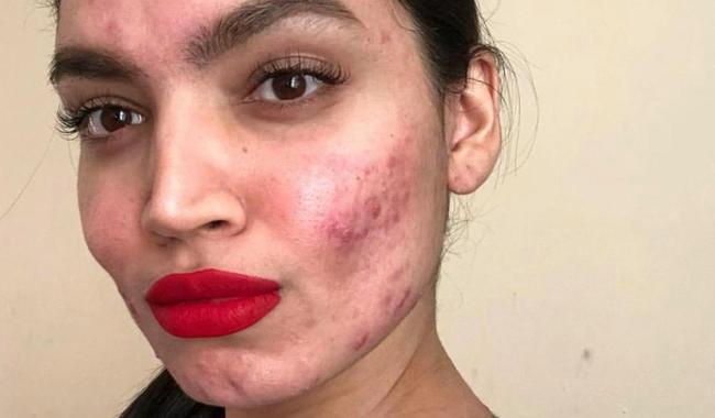 Acne sufferer Kadeeja Khan was left ‘humiliated’ when L’Oreal dropped their offer to work with her. Picture: Instagram