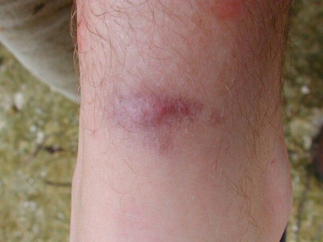 Skin irritation (‘burn’) caused by formic acid sprayed by Yellow Crazy Ants. Picture: Supplied.