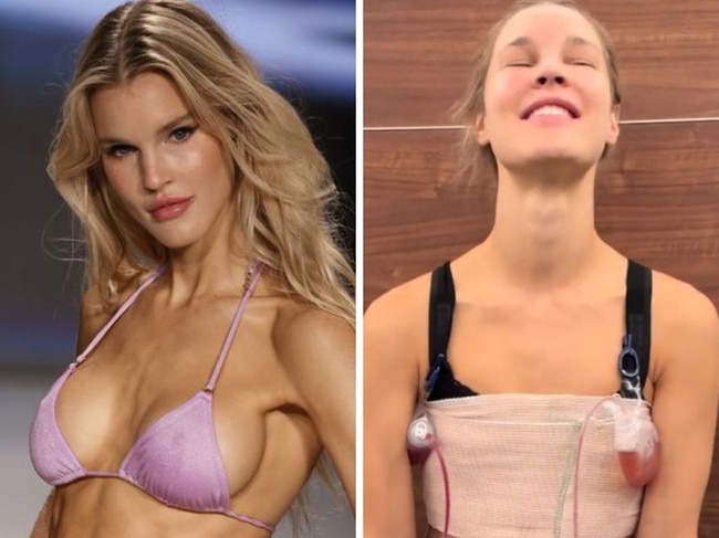 Model has breast implades removed after 12 years