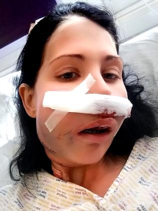 Just after surgery. Picture: Caters News