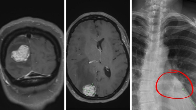 MRI images from June 3 show the major tumour in Margaret Lawson's brain – one of about seven discovered – and a tumour in her lower left lung.