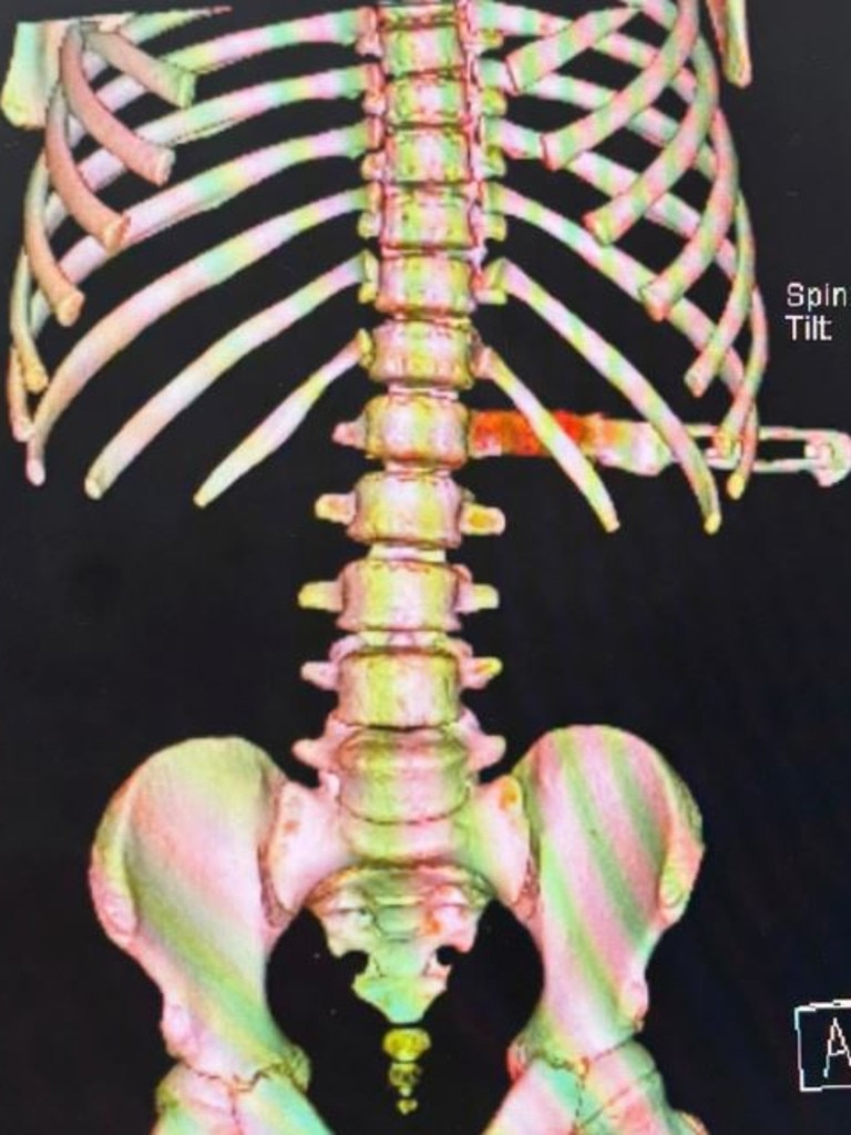 An X-ray of the knife lodged in Landon’s back. Picture: Supplied