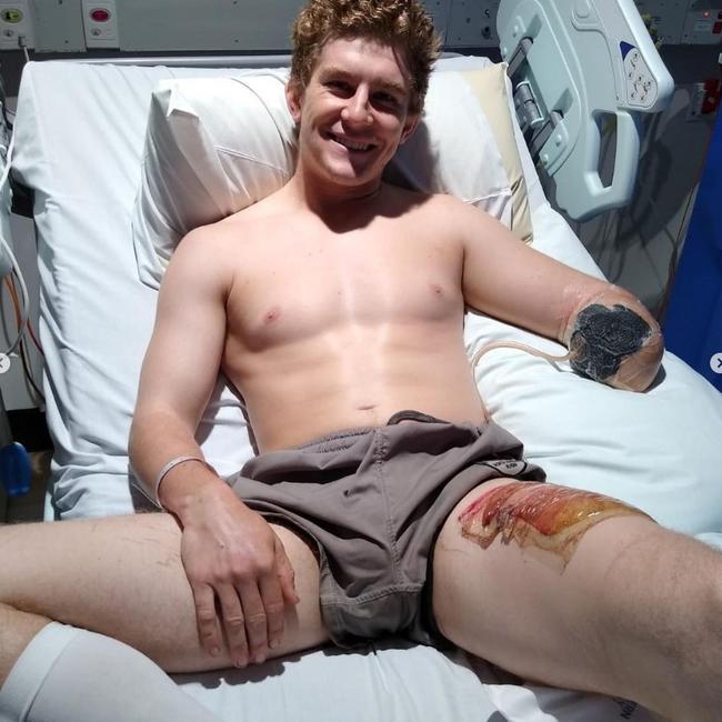 British backpacker Henry Dunn lost his lower left arm after a workplace accident on a remote Northern Territory cattle station.