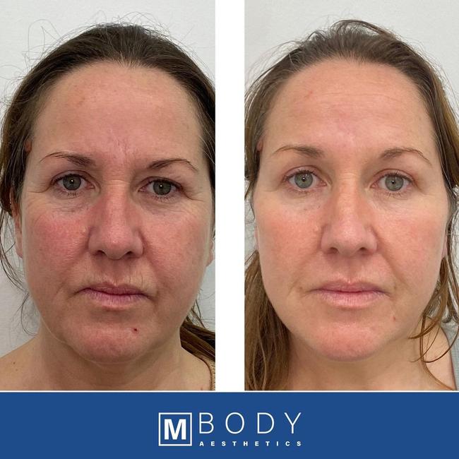 A full facial rejuvenation using filler and antiwrinkle at MBODY