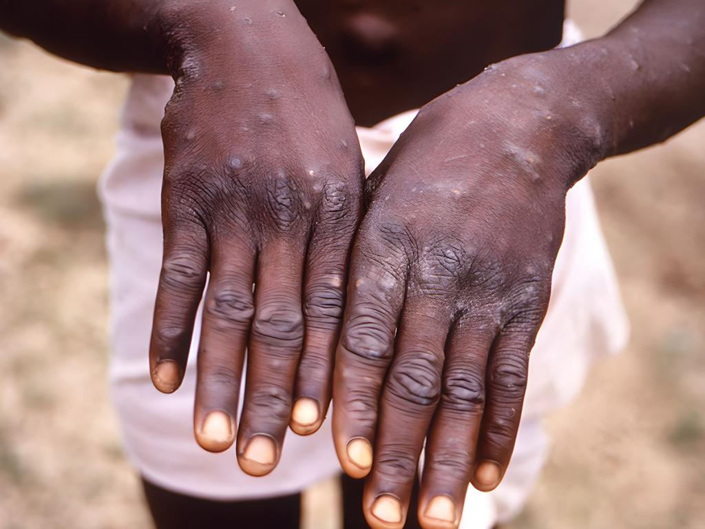 The backs of the hands of a patient with monkeypox showing a characteristic rash during his recovery phase. Picture: CDC/ Getty