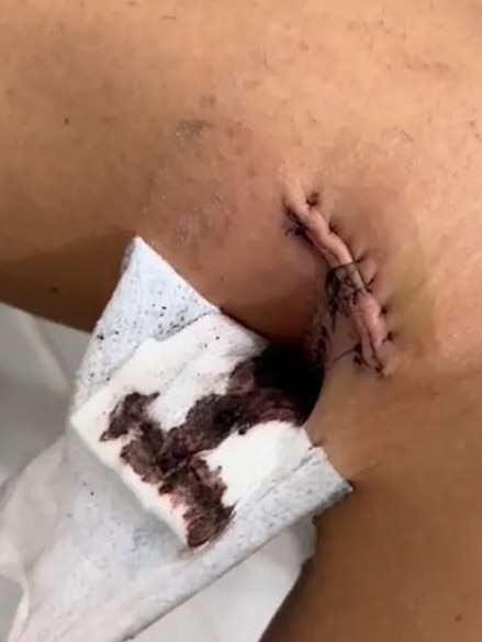 The fitness star required 30 stitches to close the wound on her leg. Picture: Instagram