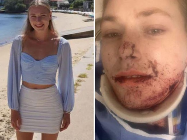 Chloe was involved in a horror car accident while on holiday in Canada