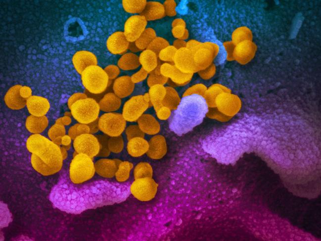 This handout illustration image obtained February 27, 2020 courtesy of the National Institutes of Health taken with a scanning electron microscope  shows SARS-CoV-2 (yellow)—also known as 2019-nCoV, the virus that causes COVID-19—isolated from a patient in the US, emerging from the surface of cells (blue/pink) cultured in the lab. - President Donald Trump has played down fears of a major coronavirus outbreak in the United States, even as infections ricochet around the world, prompting a ban on pilgrims to Saudi Arabia. China is no longer the only breeding ground for the deadly virus as countries fret over possible contagion coming from other hotbeds of infection, including Iran, South Korea and Italy. There are now more daily cases being recorded outside China than inside the country, where the virus first emerged in December, according to the World Health Organization. (Photo by Handout / National Institutes of Health / AFP) / RESTRICTED TO EDITORIAL USE - MANDATORY CREDIT "AFP PHOTO /NATIONAL INSTITUTES OF HEALTH/NIAID-RML/HANDOUT " - NO MARKETING - NO ADVERTISING CAMPAIGNS - DISTRIBUTED AS A SERVICE TO CLIENTS