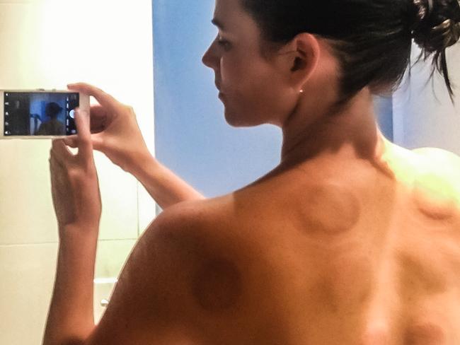 Cupping is used to promote circulation during the program. Picture: Skye Gilkeson