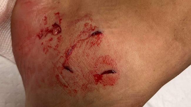 Tim McAndrew was bitten on the leg by a shark in chest-deep water at Crowdy Beach. Picture: Supplied