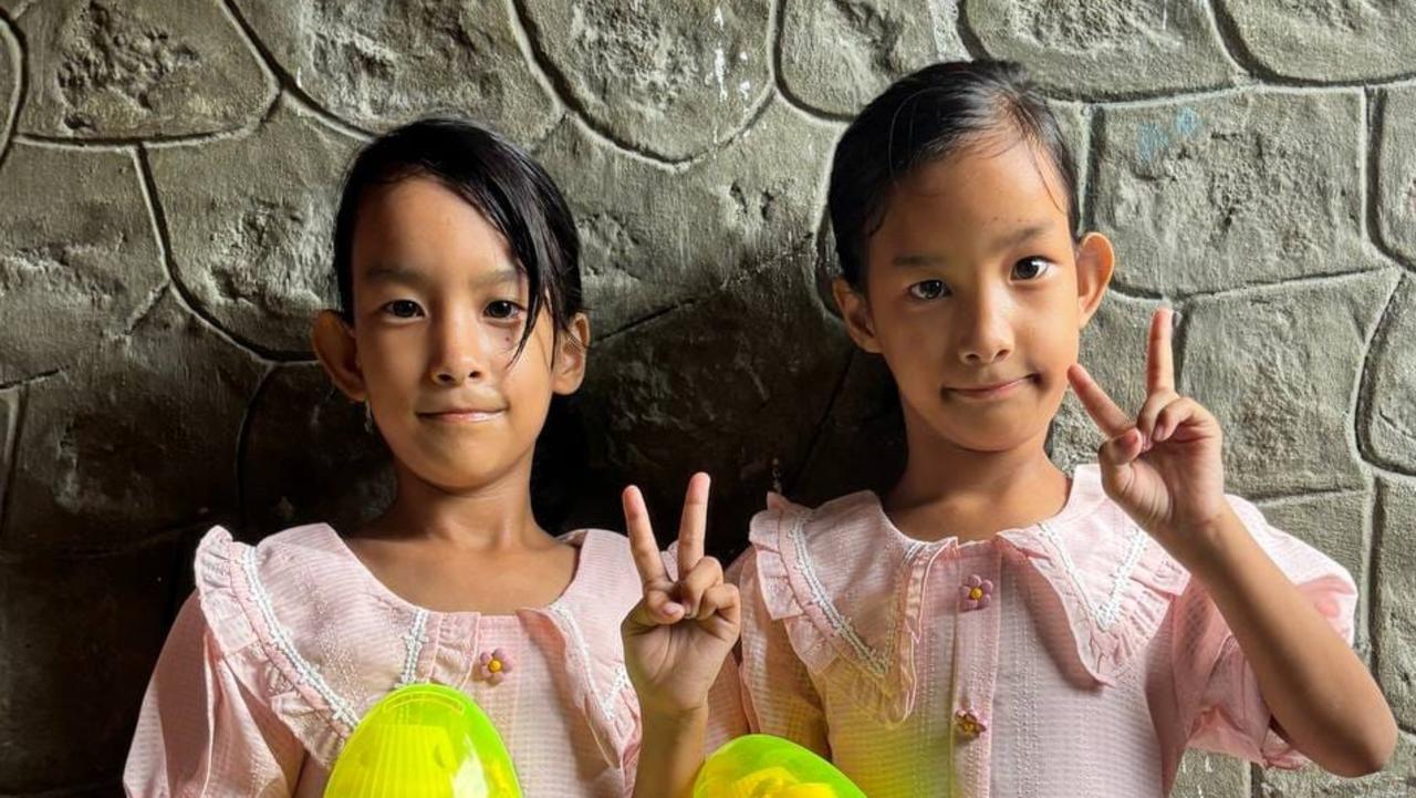 Former conjoined twins turn seven