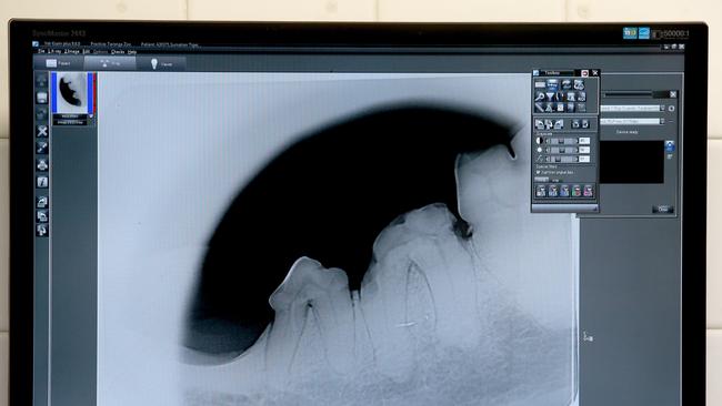 An x-ray of the tooth needing extraction (centre). Picture: Toby Zerna