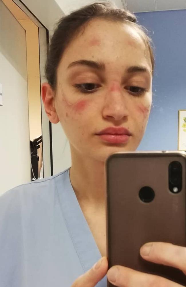 Alessia Bonari recently shared this honest photo to Instagram, revealing how poorly fitted protective gear had bruised her face. Picture: Instagram/Alessiabonari