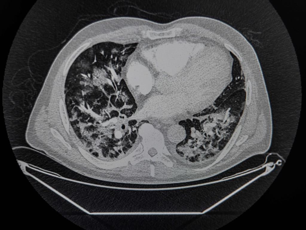 A scanner shows the lungs of a patient infected with COVID-19. Picture: AFP