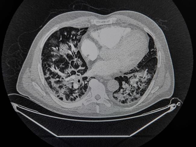 A scanner shows the lungs of a patient infected with COVID-19. Picture: AFP