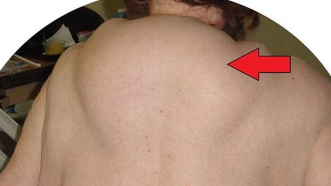 Cause of Buffalo Hump on Back of the Neck and Its Powerful