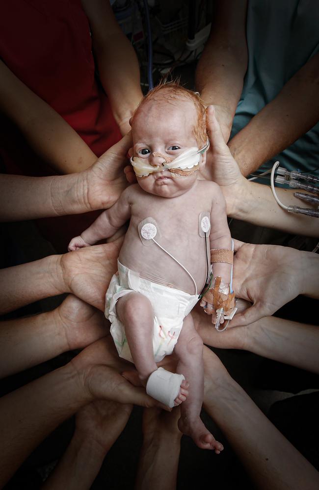 Two month old Sonny has a kidney abnormality called Bartter's syndrome needing complex fluid management. Picture: David Caird