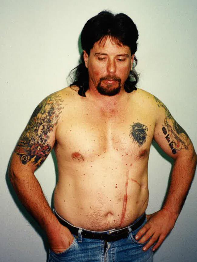 Syd Collins, showing scars he received after being shot by Mark Chopper Read