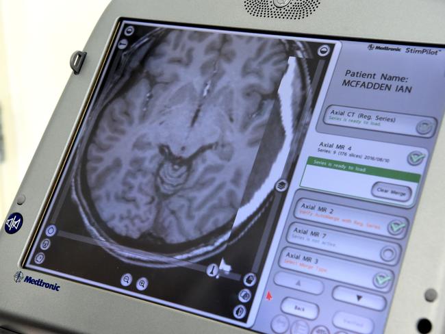 Parkinsons Sufferer Ian Mcfaddens Remarkable Brain Surgery Journey At