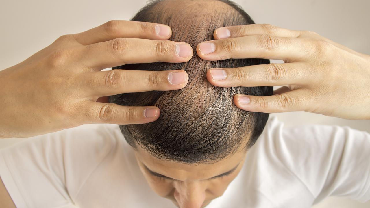 Hair loss treatment: dermatologists report incredible results for minoxidil   — Australia's leading news site