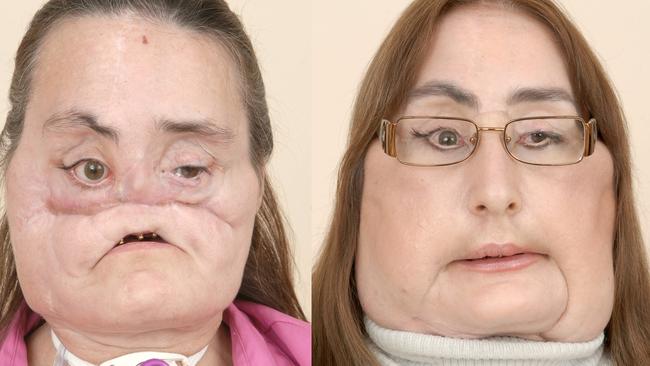 Connie Culp before and after her transplant surgery. Picture: AP