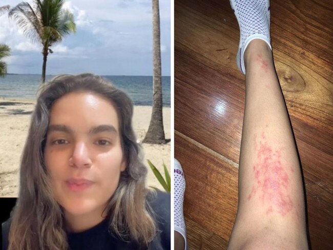 Woman discovers parasite living in leg after beach holiday