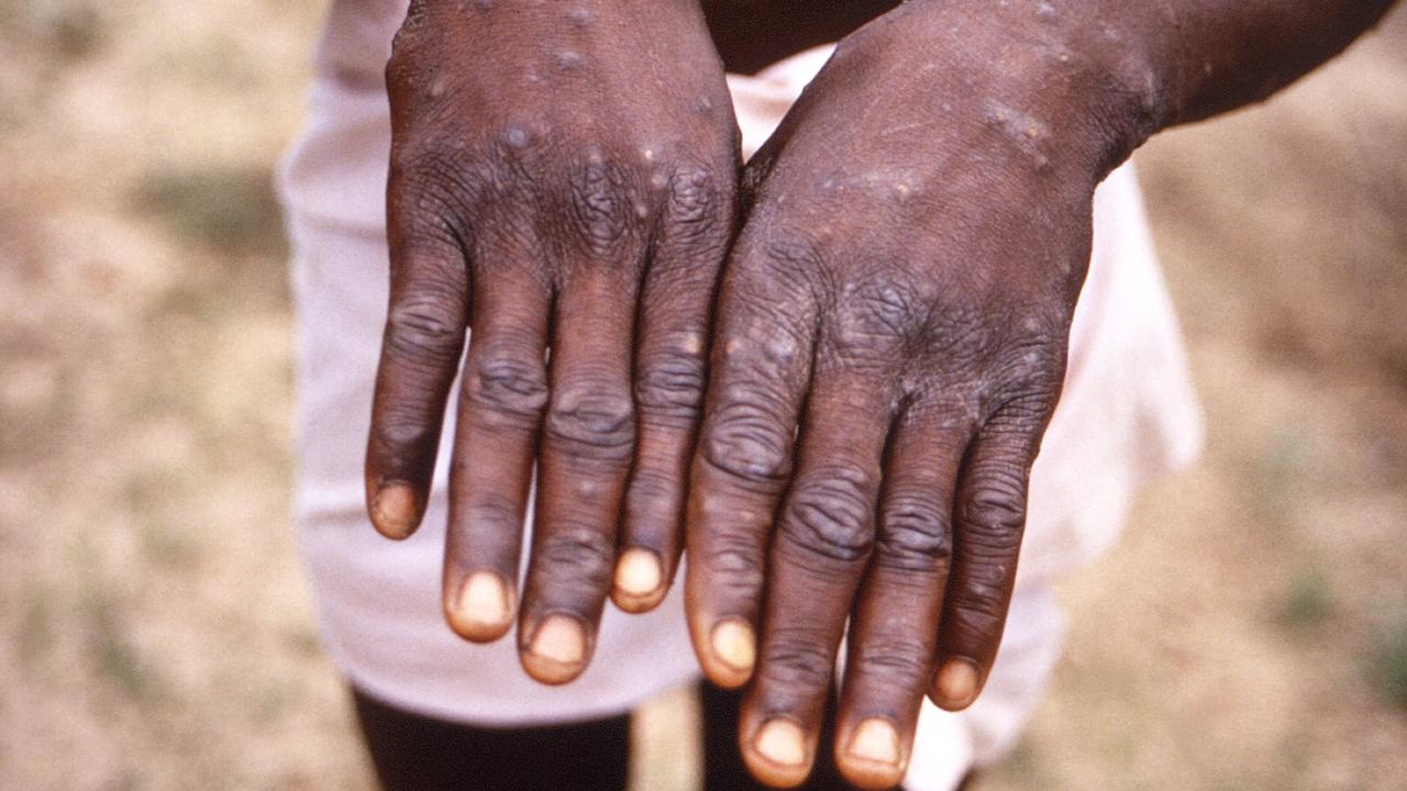 The dorsal surfaces of a monkeypox case in a patient who was displaying the appearance of the characteristic rash during its recuperative stage, pictured in 1997. Picture: Brian W.J. Mahy/Centers for Disease Control and Prevention/AFP