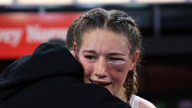 Tayla Harris was sporting a huge shiner. (Photo by Mark Evans/Getty Images)