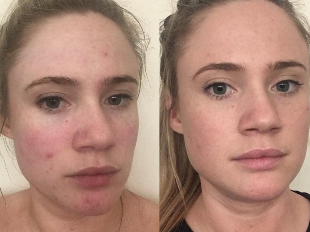 Kayla’s skin at age 27 (left), then three months after using Tribe Skincare (right). Picture: Supplied.