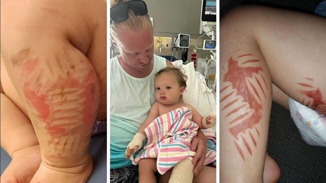 Parents have come forward with horrifying stories of toddlers suffering ‘checkerboard’ burns in the blink of an eye including Emma Ferrarto’s daughter (at centre) who suffered shocking burns recently at Port Macquarie. Olivia’s burns are pictured at right.