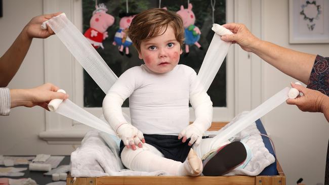 WARNING HOLD FOR Good Friday Appeal 2024 at the RCH. Jacob Burmeister 2, Butterfly Boy. Jacob has  Recessive Dystrophic Epidermolysis Bullosa whole body is bandaged to prevent blisters and wounds. Jacob endures a daily full body bandage change, skin check and wound dressing that can take more than 2 hours.                   Picture: David Caird