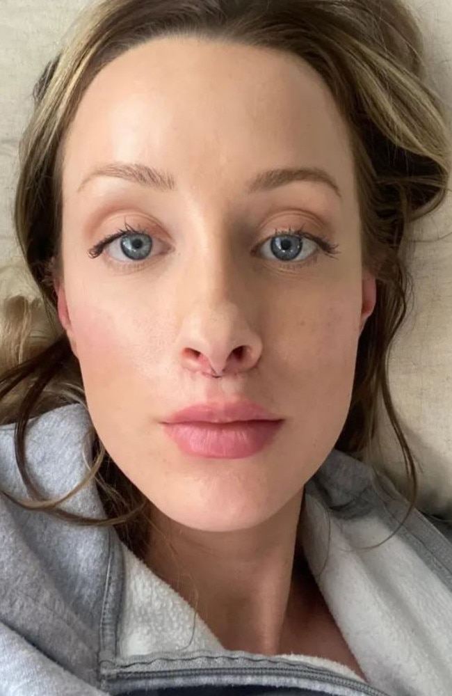 Jessie Barnes a few days after her lip lift surgery, with sutures still visible. Picture: Supplied