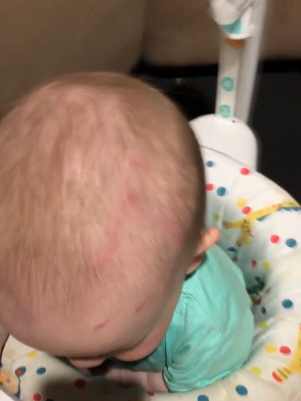 A Brisbane family claims their son Jack was left battered and bruised by an older child while at daycare. Picture: ABC 7.30/Angela Swindells