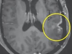 A woman's brain tumour nearly completely regressed five days after having CAR-T therapy. Picture: New England Journal of Medicine