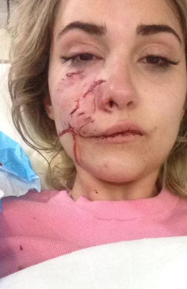 Suzel Mackintosh said she was left 'looking like the joker' after being mauled by a devil dog.