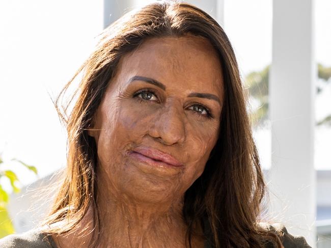 Turia Pitt pictures for SMARTdaily only., Picture: Supplied